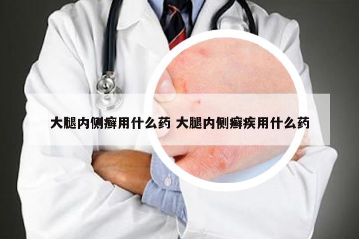 大腿内侧癣用什么药 大腿内侧癣疾用什么药