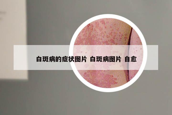 白斑病的症状图片 白斑病图片 自愈