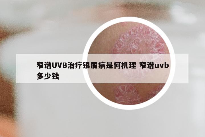 窄谱UVB治疗银屑病是何机理 窄谱uvb多少钱