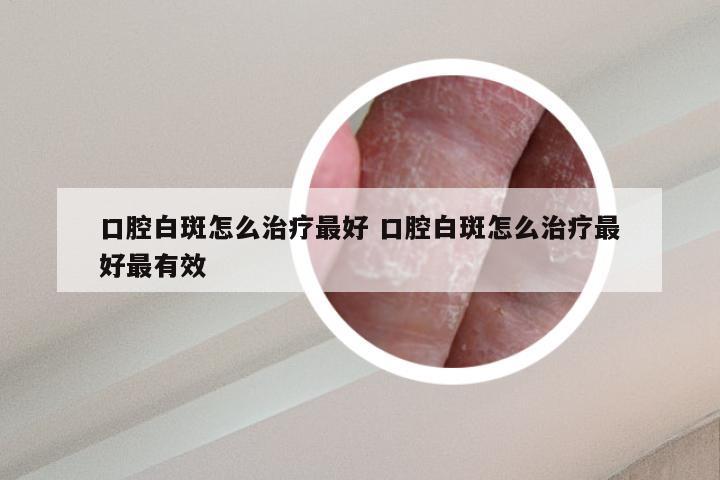 口腔白斑怎么治疗最好 口腔白斑怎么治疗最好最有效