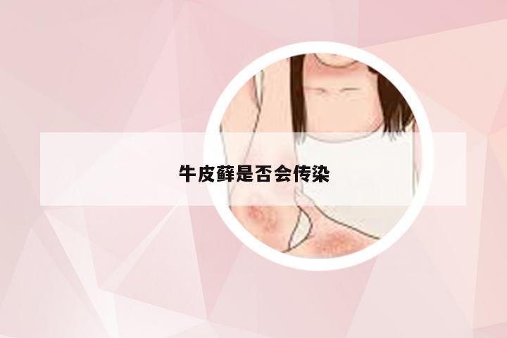 牛皮藓是否会传染