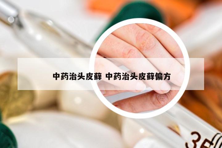 中药治头皮藓 中药治头皮藓偏方