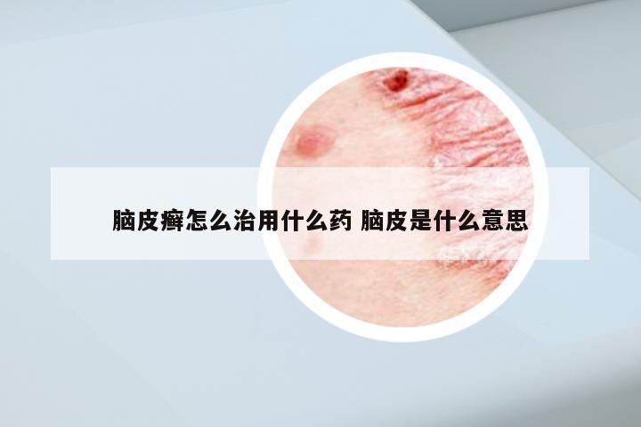 脑皮癣怎么治用什么药 脑皮是什么意思