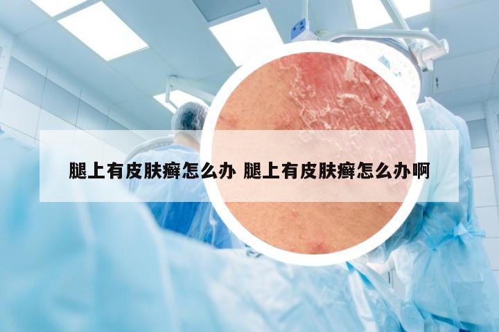 腿上有皮肤癣怎么办 腿上有皮肤癣怎么办啊