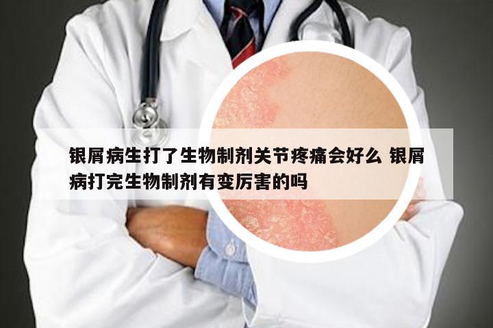 银屑病生打了生物制剂关节疼痛会好么 银屑病打完生物制剂有变厉害的吗