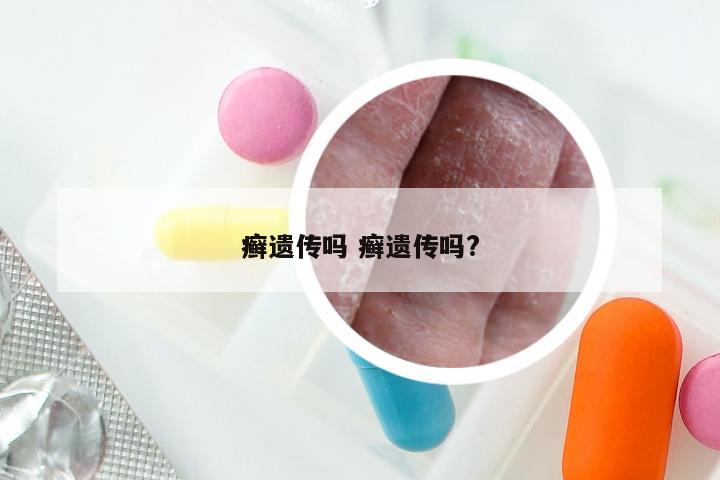 癣遗传吗 癣遗传吗?