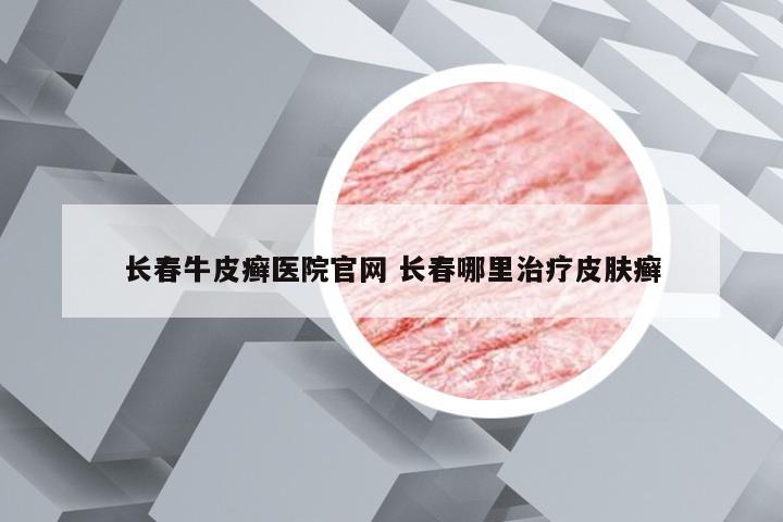 长春牛皮癣医院官网 长春哪里治疗皮肤癣