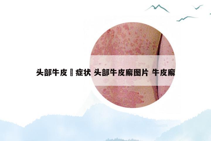 头部牛皮廯症状 头部牛皮廨图片 牛皮廨