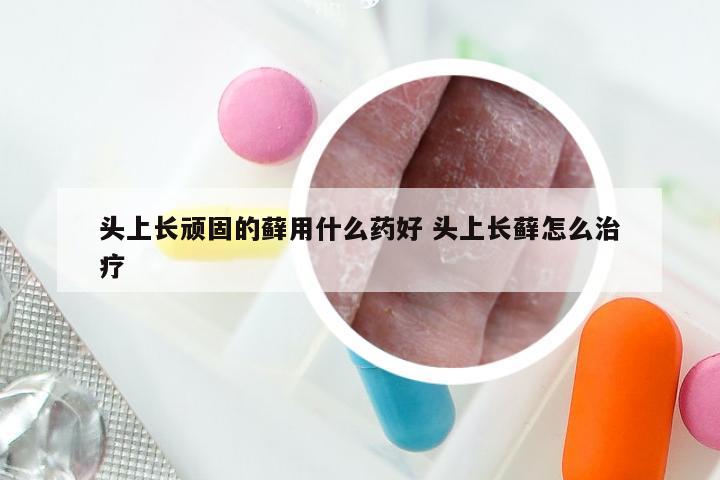 头上长顽固的藓用什么药好 头上长藓怎么治疗