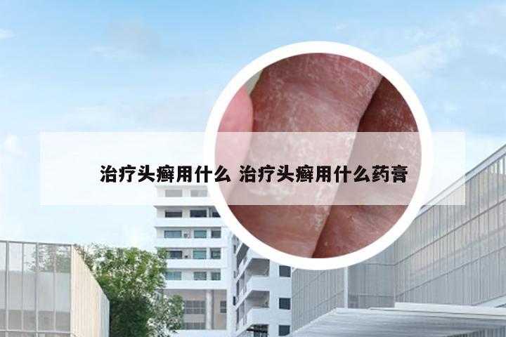 治疗头癣用什么 治疗头癣用什么药膏