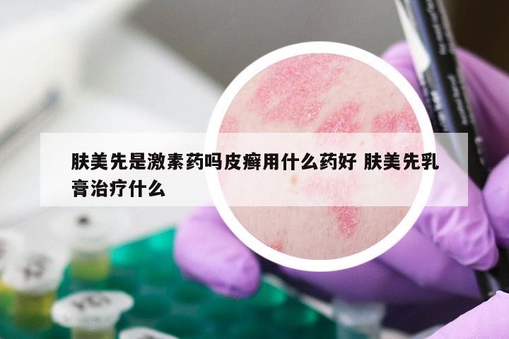 肤美先是激素药吗皮癣用什么药好 肤美先乳膏治疗什么