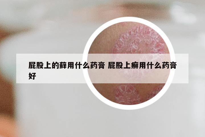 屁股上的藓用什么药膏 屁股上癣用什么药膏好