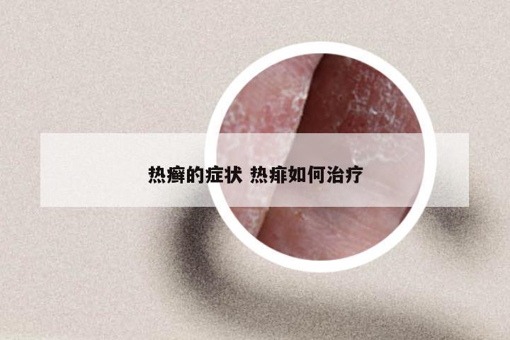 热癣的症状 热痱如何治疗