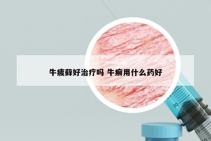 牛疲藓好治疗吗 牛癣用什么药好