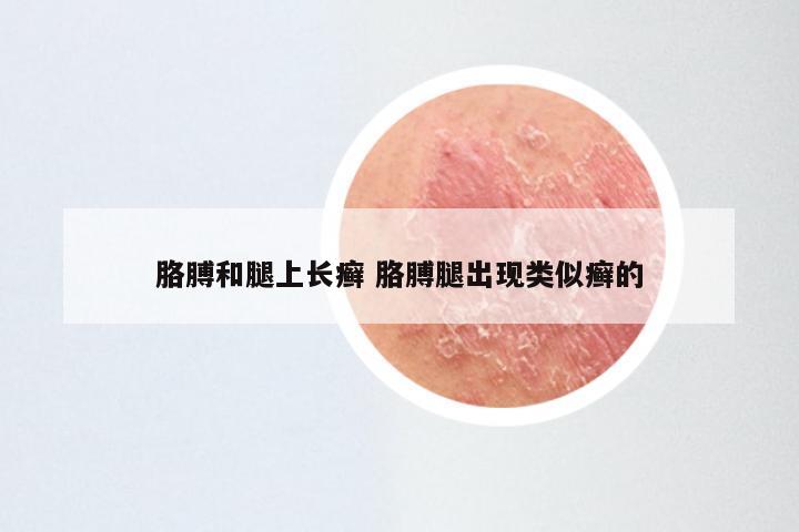 胳膊和腿上长癣 胳膊腿出现类似癣的