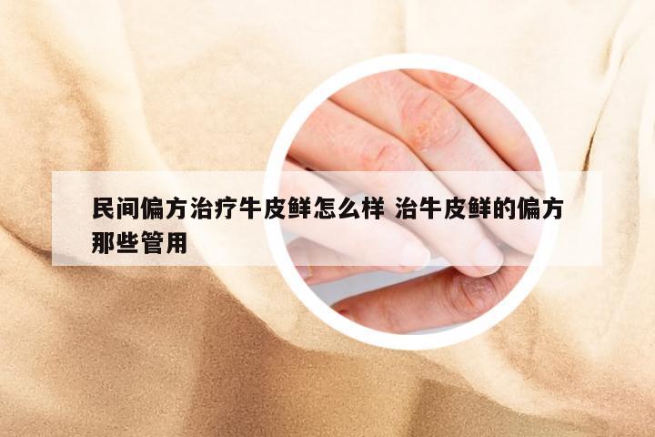 民间偏方治疗牛皮鲜怎么样 治牛皮鲜的偏方那些管用