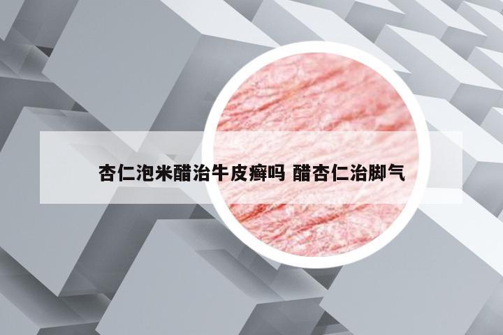 杏仁泡米醋治牛皮癣吗 醋杏仁治脚气