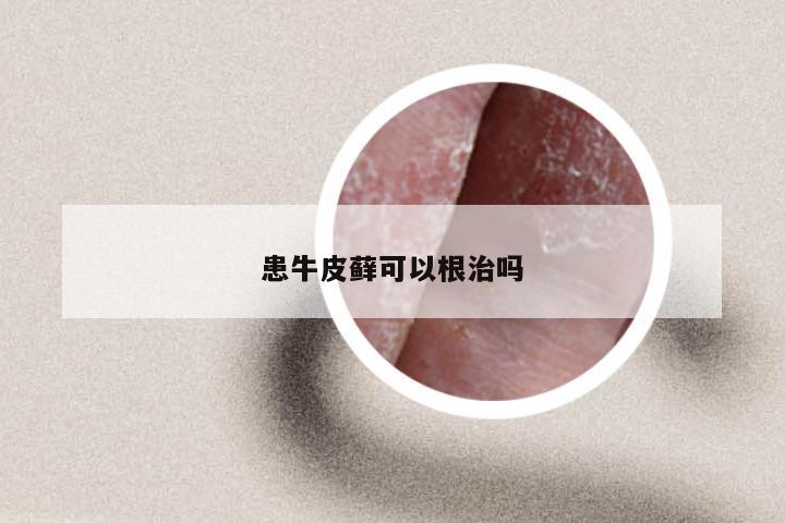 患牛皮藓可以根治吗