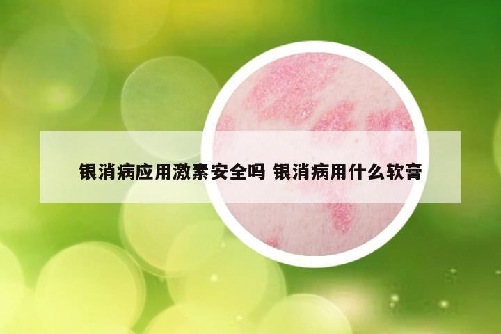 银消病应用激素安全吗 银消病用什么软膏