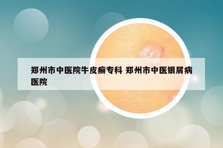 郑州市中医院牛皮癣专科 郑州市中医银屑病医院