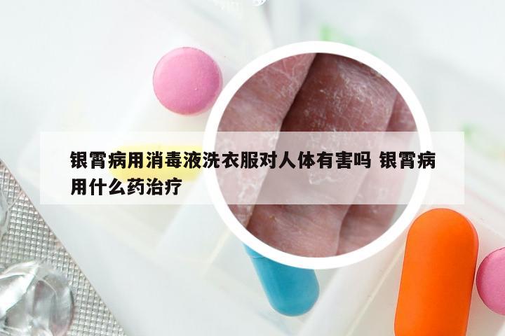 银霄病用消毒液洗衣服对人体有害吗 银霄病用什么药治疗