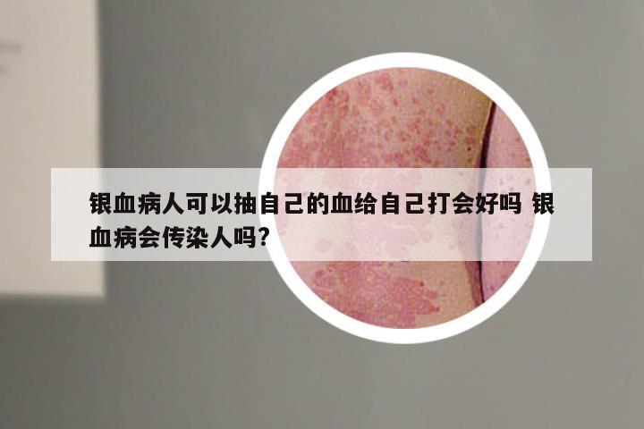 银血病人可以抽自己的血给自己打会好吗 银血病会传染人吗?