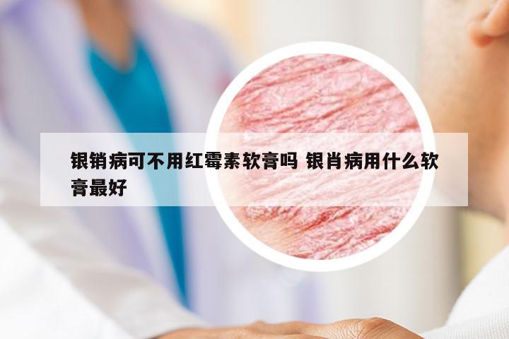 银销病可不用红霉素软膏吗 银肖病用什么软膏最好