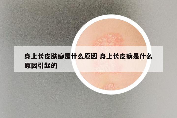 身上长皮肤癣是什么原因 身上长皮癣是什么原因引起的