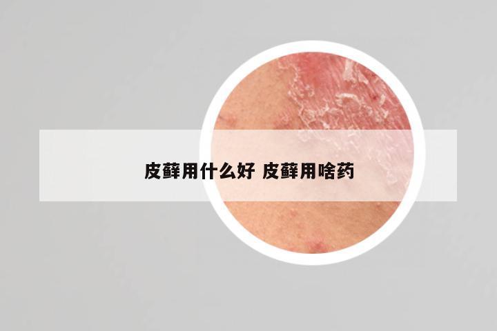 皮藓用什么好 皮藓用啥药