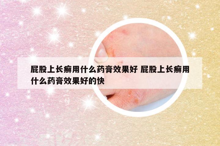 屁股上长癣用什么药膏效果好 屁股上长癣用什么药膏效果好的快