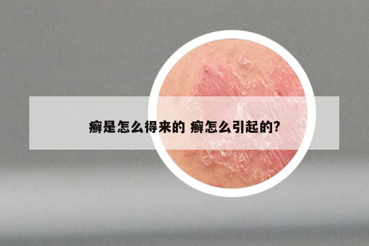 癣是怎么得来的 癣怎么引起的?