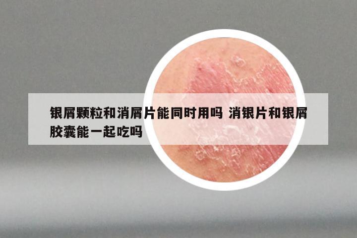 银屑颗粒和消屑片能同时用吗 消银片和银屑胶囊能一起吃吗