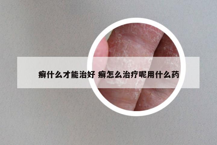 癣什么才能治好 癣怎么治疗呢用什么药