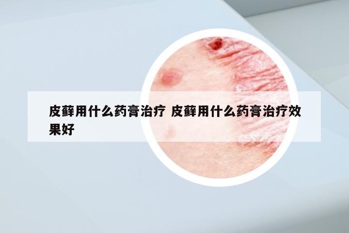 皮藓用什么药膏治疗 皮藓用什么药膏治疗效果好