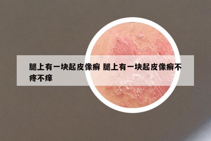 腿上有一块起皮像癣 腿上有一块起皮像癣不疼不痒