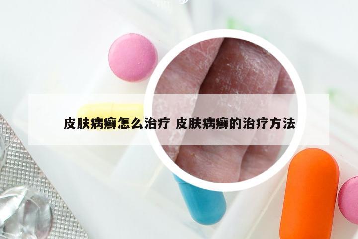 皮肤病癣怎么治疗 皮肤病癣的治疗方法