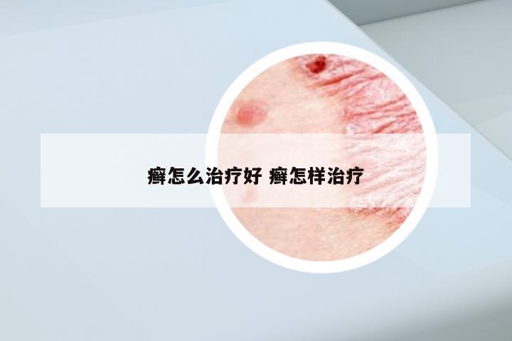 癣怎么治疗好 癣怎样治疗