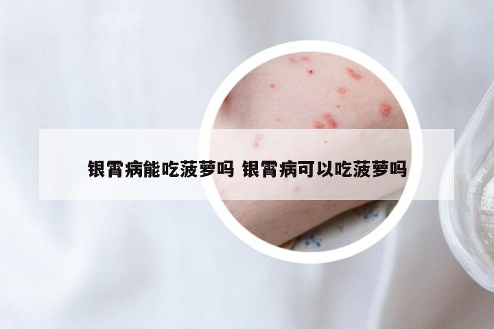 银霄病能吃菠萝吗 银霄病可以吃菠萝吗