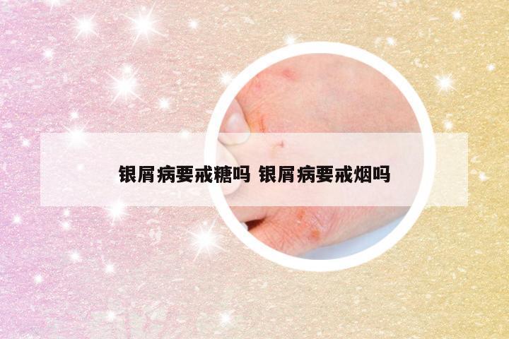 银屑病要戒糖吗 银屑病要戒烟吗