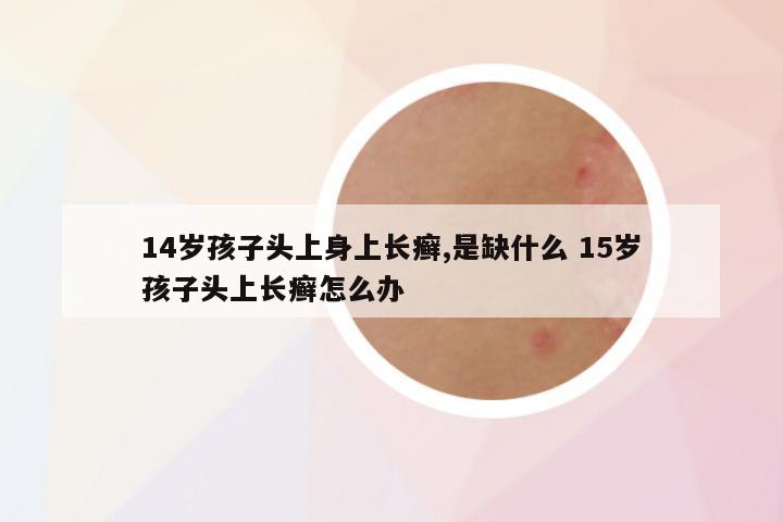 14岁孩子头上身上长癣,是缺什么 15岁孩子头上长癣怎么办