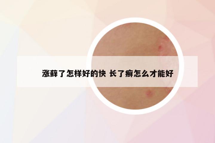 涨藓了怎样好的快 长了癣怎么才能好