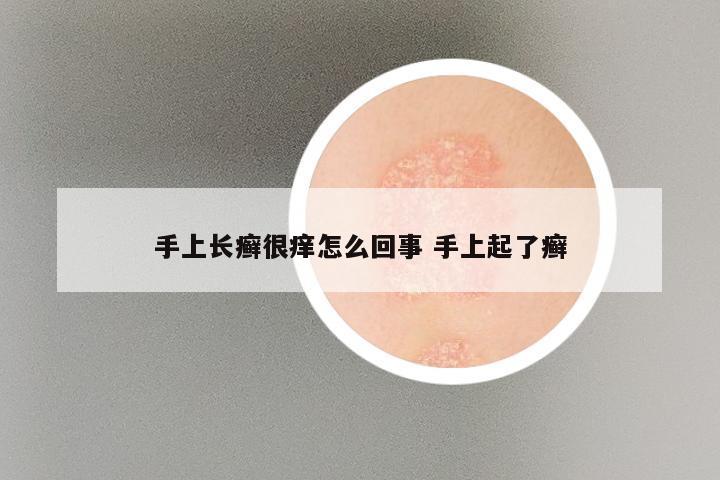 手上长癣很痒怎么回事 手上起了癣