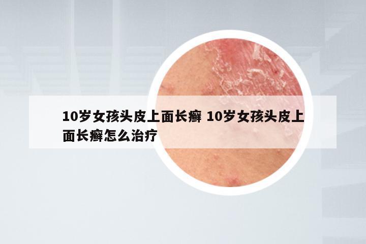 10岁女孩头皮上面长癣 10岁女孩头皮上面长癣怎么治疗