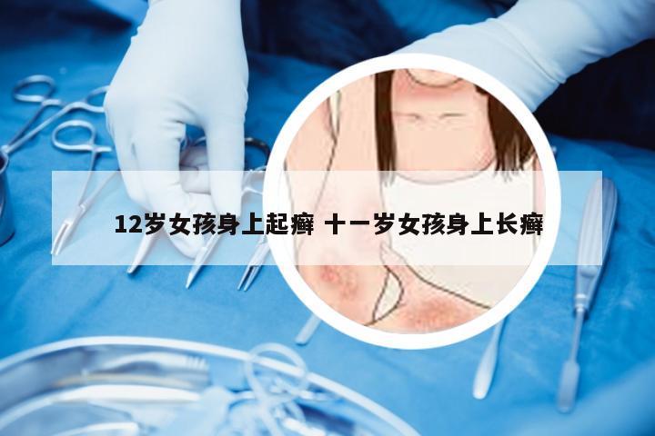 12岁女孩身上起癣 十一岁女孩身上长癣