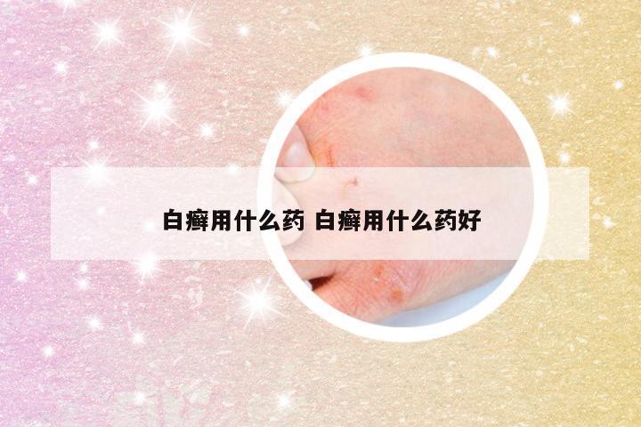 白癣用什么药 白癣用什么药好