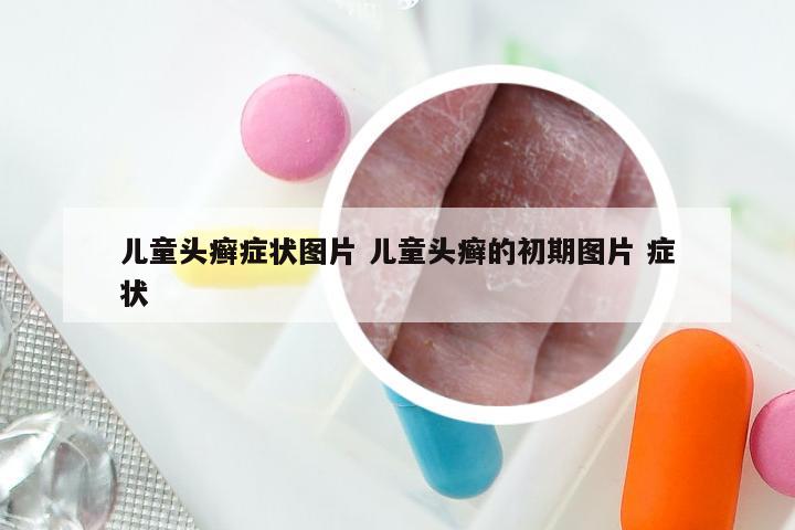 儿童头癣症状图片 儿童头癣的初期图片 症状