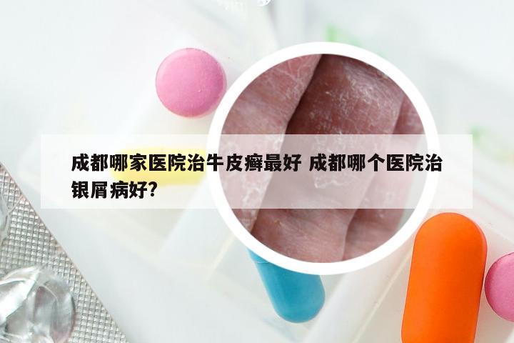 成都哪家医院治牛皮癣最好 成都哪个医院治银屑病好?