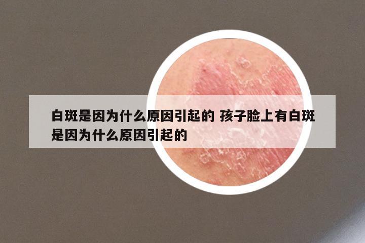 白斑是因为什么原因引起的 孩子脸上有白斑是因为什么原因引起的