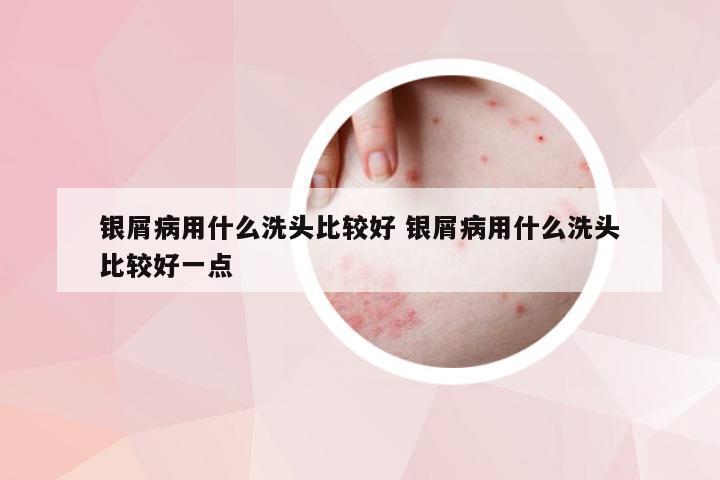 银屑病用什么洗头比较好 银屑病用什么洗头比较好一点