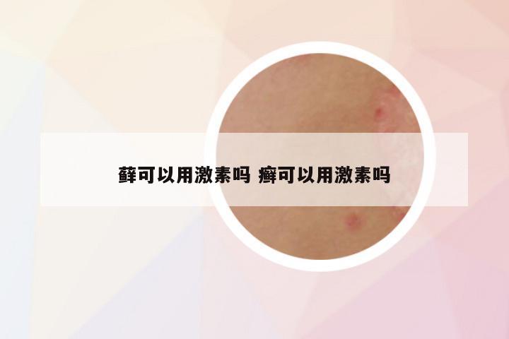 藓可以用激素吗 癣可以用激素吗